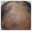 生化三联综合疗法，激活毛囊轻松告别脱发