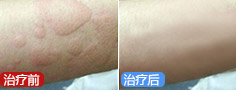个性化治疗荨麻疹，让他重回正常生活