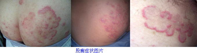 股癣