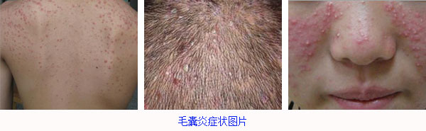 毛囊炎