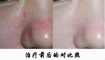 酒糟鼻