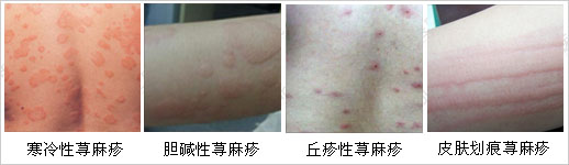 荨麻疹