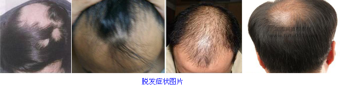 脱发