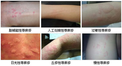 荨麻疹